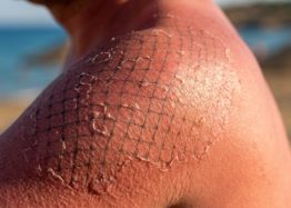 How the Immune System Makes Sun Damage Worse