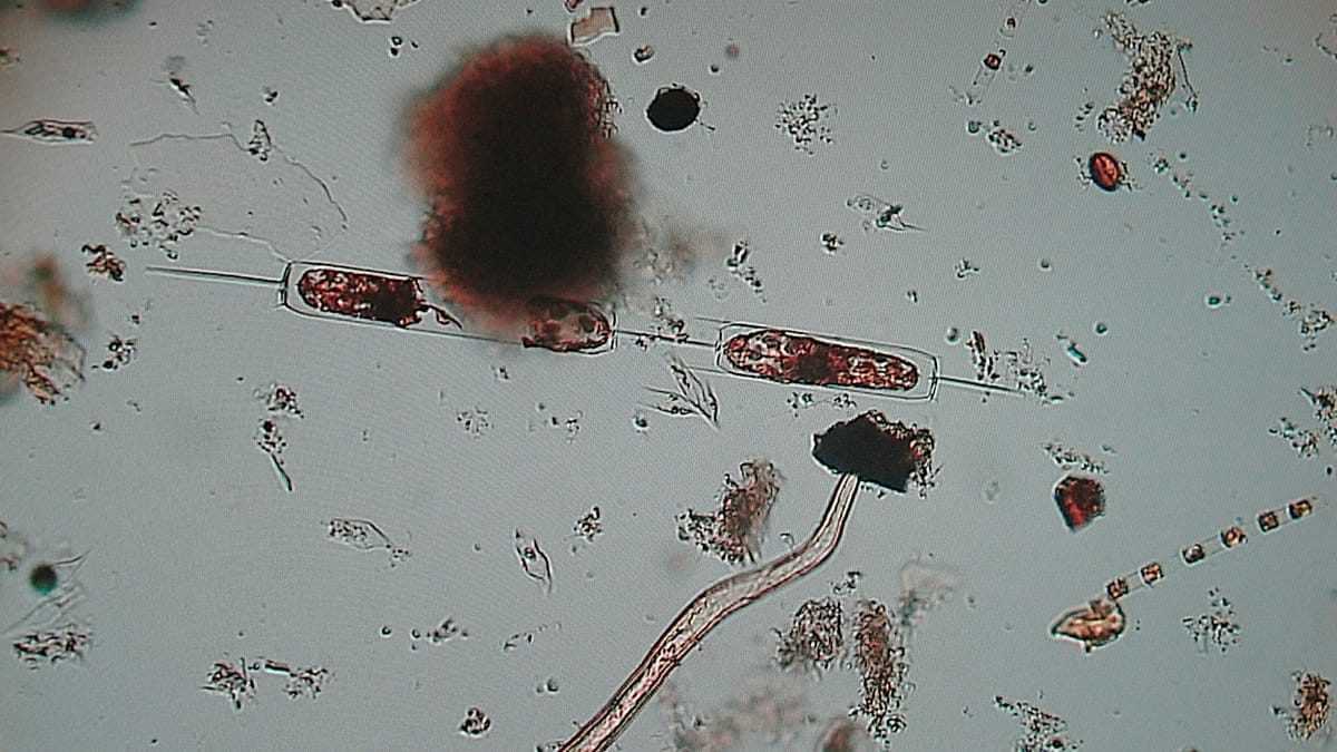 Recent outbreaks of 'flesh-eating bacteria' worldwide
