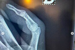 Myriam Nicole Breaks and Dislocates Finger at the Andorra DH World Cup