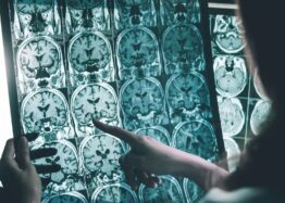 Glycosylation’s Role in Alzheimer’s Disease