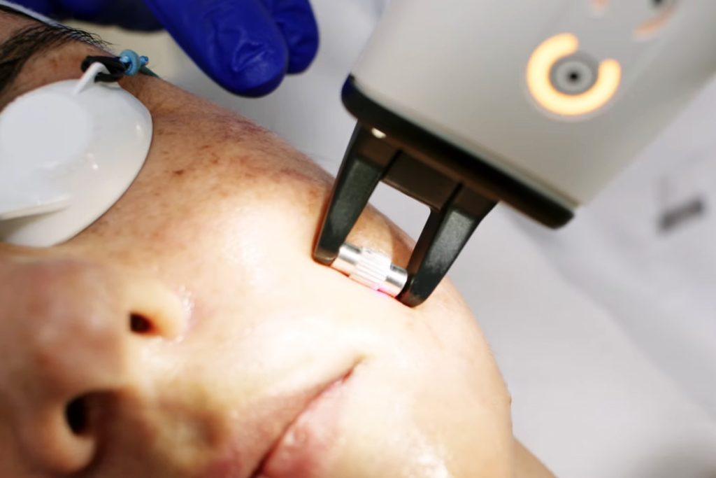 Laser treatment found to reverse skin aging markers